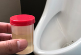 Dijagnostička evaluacija simptoma donjeg urinarnog trakta (LUTS) - 2. dio