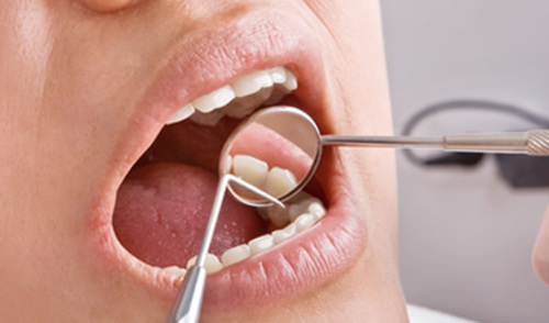 Zamijeniti ili popraviti metalni zubni ispun?