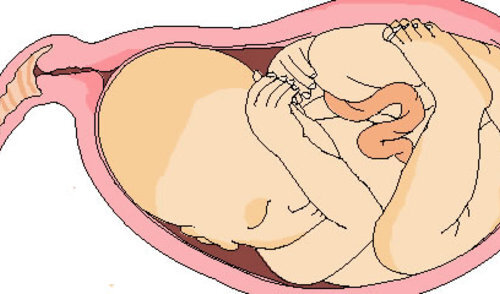 Način rađanja ne utječe na postporođajni stres 