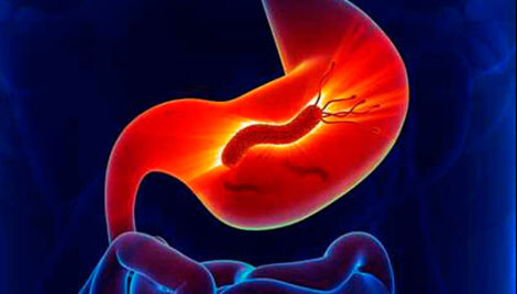 Peptički ulkus induciran acetilsalicilnom kiselinom i infekcija s H. pylori Peptički ulkus induciran acetilsalicilnom kiselinom i infekcija s H. pylori
