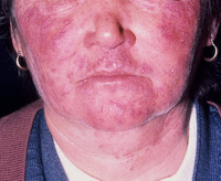 Dermatitis steroidica rosaceiformis