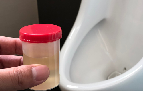Dijagnostička evaluacija simptoma donjeg urinarnog trakta (LUTS) - 2. dio