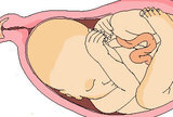 Transfer smrznutih embrija rezultira rađanjem veće i teže djece