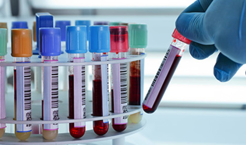 Ljudi s dugim COVID-19 imaju specifične biomarkere u krvi