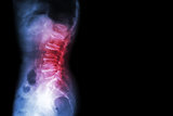 Spinalni implantat - prevencija padova kod uznapredovale Parkinsonove bolesti