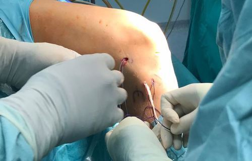 Hrvatski liječnici razvili novu kiruršku tehniku operacije ligamenata koljena