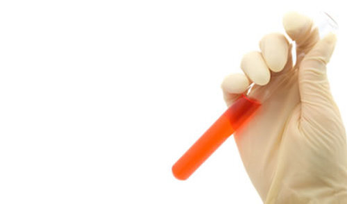 HIV uzrokuje oštećenje srčanog mišića HIV uzrokuje oštećenje srčanog mišića