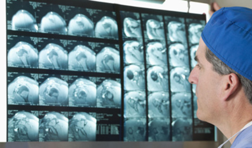 Kompjutorizirana tomografija plućnih komplikacija izvanbolničke pneumonije