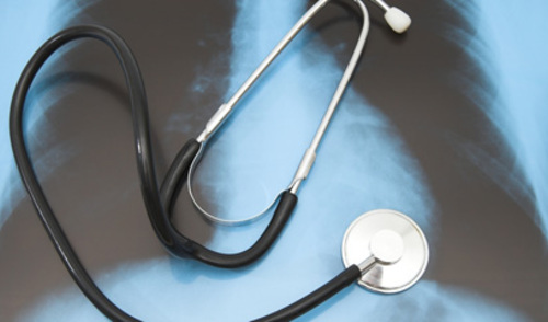 Rijetki tumor pluća u dječjoj dobi – inflamatorni miofibroblastični tumor Rijetki tumor pluća u dječjoj dobi – inflamatorni miofibroblastični tumor