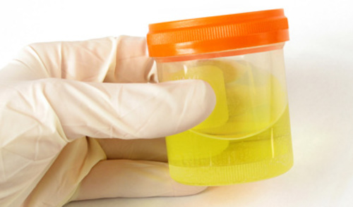 Detekcija spolno-prenosivih patogena u uzorcima prvog mlaza urina 