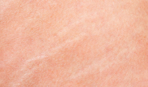 Kožne nuspojave povezane s primjenom amlodipina