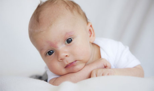 Blaža dojenačka hiperkalcemija ima dobar klinički ishod