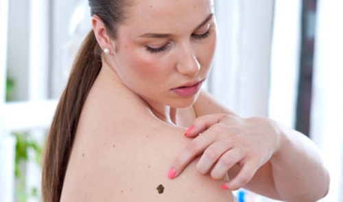 Maligni blue naevus kao primarno sijelo recidivirajućih metastaza melanoma Maligni blue naevus kao primarno sijelo recidivirajućih metastaza melanoma