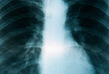 Diferencijalna dijagnoza intersticijske pneumonije u vrijeme COVID-19 pandemije