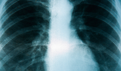 Porast smrtnosti od raka pluća kod žena
