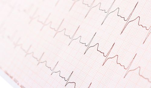 KBC Zagreb: Inovativno liječenje aritmije srca radioablacijskom tehnologijom KBC Zagreb: Inovativno liječenje aritmije srca radioablacijskom tehnologijom