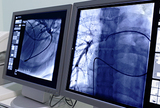 CT ili invazivna koronarografija kod stabilne angine pektoris?