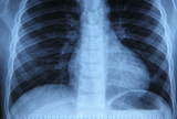 Povijest tuberkuloze s osvrtom na asanaciju i tuberkulozu u Mraclinu
