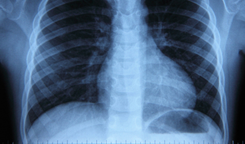 Patogeni izvanbolnički stečene pneumonije u odraslih često nisu identificirani