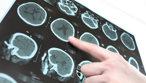 Kompjutorska tomografija glave kod djece s izoliranom frakturom ekstremiteta