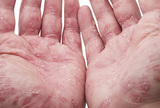 Povezanost pranja ruku i kontaktnog dermatitisa kod zdravstvenog osoblja 