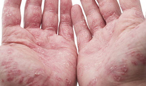Povezanost pranja ruku i kontaktnog dermatitisa kod zdravstvenog osoblja 