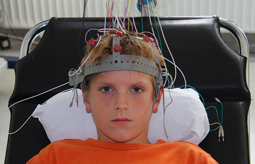 Smjernice za farmakoterapiju epilepsija u djece i adolescenata  Smjernice za farmakoterapiju epilepsija u djece i adolescenata